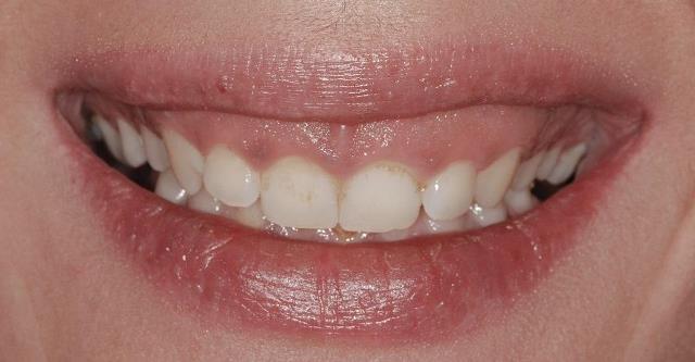 Также десневую улыбку называют синдромом коротких зубов