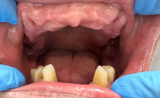 Пациенту 63 года, многих зубов нет, щеки впали, дикция сильно нарушена