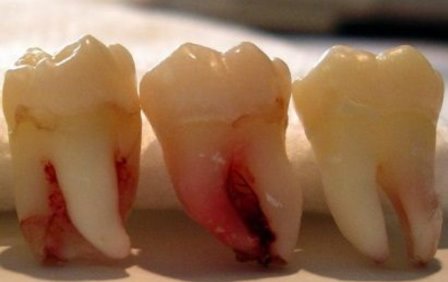 Гемисекция - удаление одного из корней многокорневого зуба