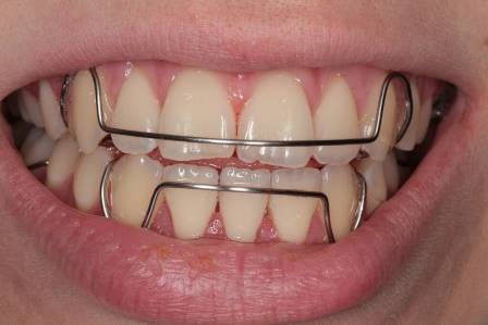 Ретейнеры фиксируют зубы в правильном положении, не давая им смещаться после снятия брекетов
