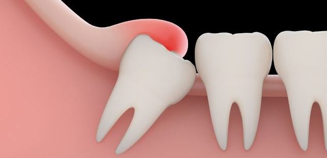 Перикоронит - это воспаление мягких тканей частично прорезавшегося зуба